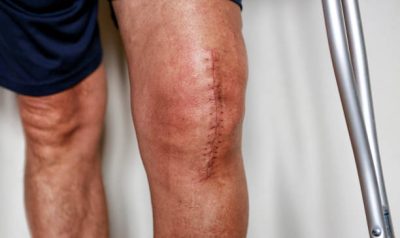 Image of a man's knee after knee replacement surgery